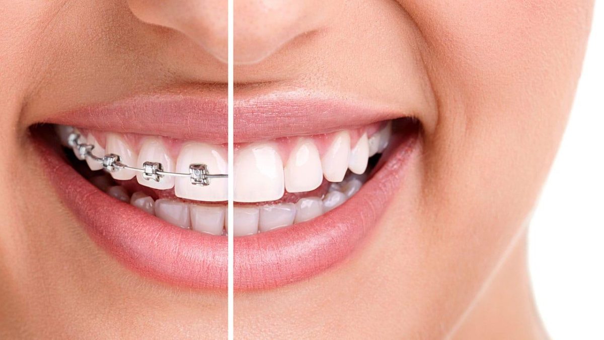 نساعدك في الحصول على ابتسامة متناسقة وجميلة باستخدام تقويم الأسنان سواء المعدني أو الانفزلاين بحسب رغبتك وحاجة أسنانك.